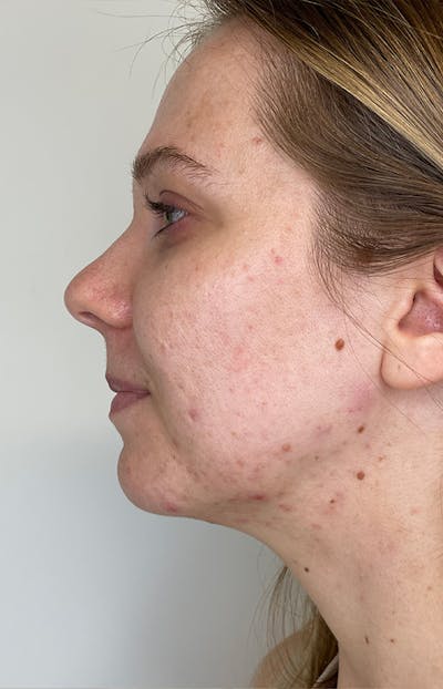 Acne Treatment Before & After Gallery - Patient 326187 - Image 4