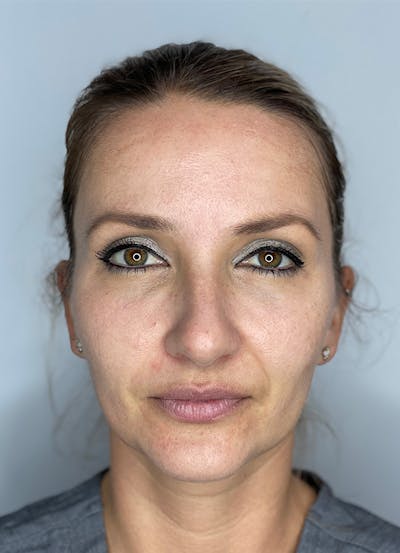 Chemical Peels Before & After Gallery - Patient 407096 - Image 1