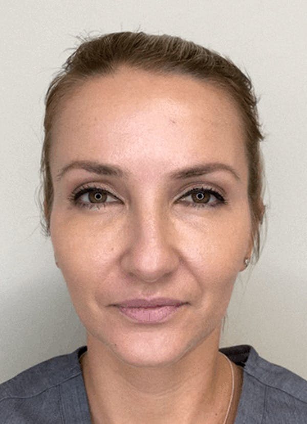Chemical Peels Before & After Gallery - Patient 407096 - Image 2