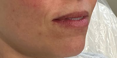 Lip Filler Before & After Gallery - Patient 810121 - Image 1