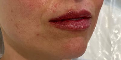 Lip Filler Before & After Gallery - Patient 810121 - Image 2