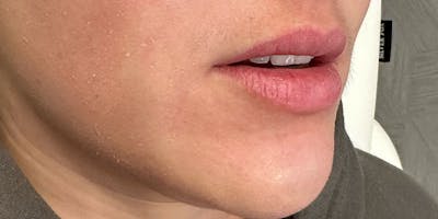 Lip Filler Before & After Gallery - Patient 142559 - Image 1