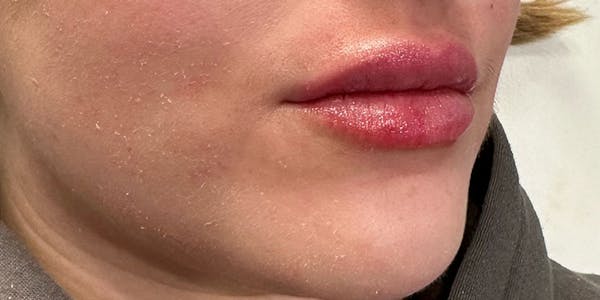 Lip Filler Before & After Gallery - Patient 142559 - Image 2