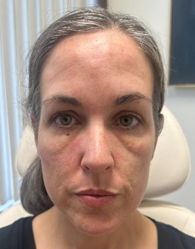 Cheek Filler Before & After Gallery - Patient 374959 - Image 1