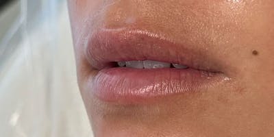 Lip Filler Before & After Gallery - Patient 378093 - Image 1