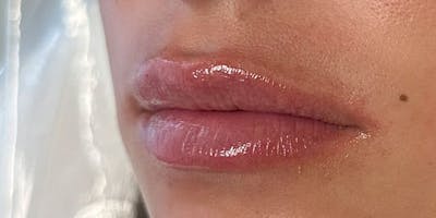 Lip Filler Before & After Gallery - Patient 378093 - Image 2