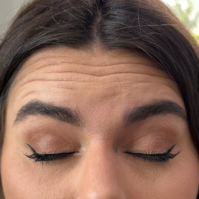 Botox Before & After Gallery - Patient 971146 - Image 1