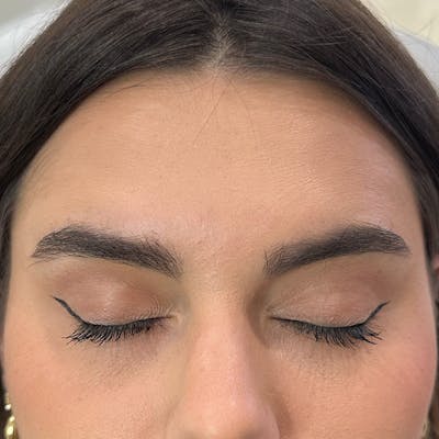 Botox Before & After Gallery - Patient 971146 - Image 2