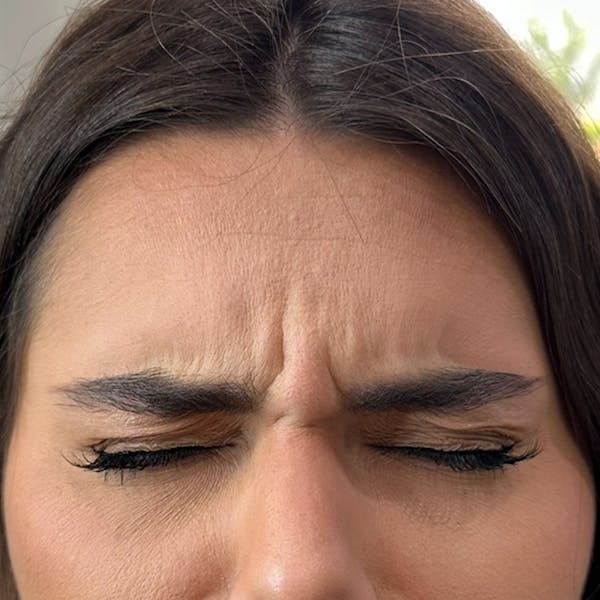Botox Before & After Gallery - Patient 971146 - Image 3