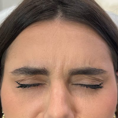 Botox Before & After Gallery - Patient 971146 - Image 4
