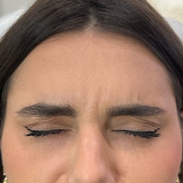 Botox Before & After Gallery - Patient 971146 - Image 4