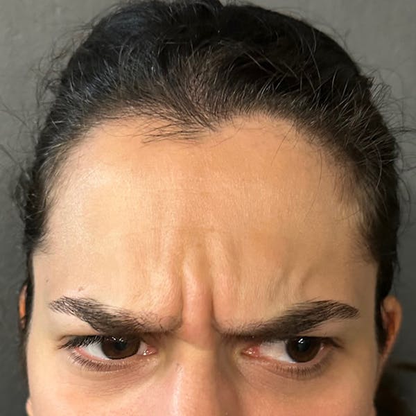 Botox Before & After Gallery - Patient 329497 - Image 1