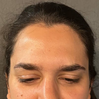 Botox Before & After Gallery - Patient 329497 - Image 2