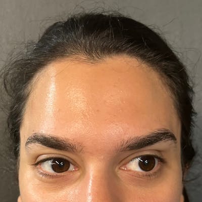 Botox Before & After Gallery - Patient 329497 - Image 4