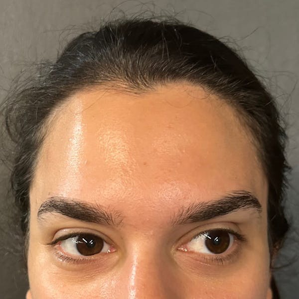 Botox Before & After Gallery - Patient 329497 - Image 4