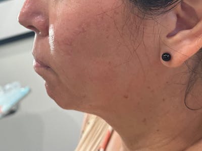 Chin Filler Before & After Gallery - Patient 934061 - Image 1