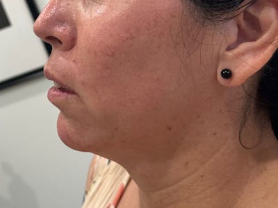 Chin Filler Before & After Gallery - Patient 934061 - Image 2