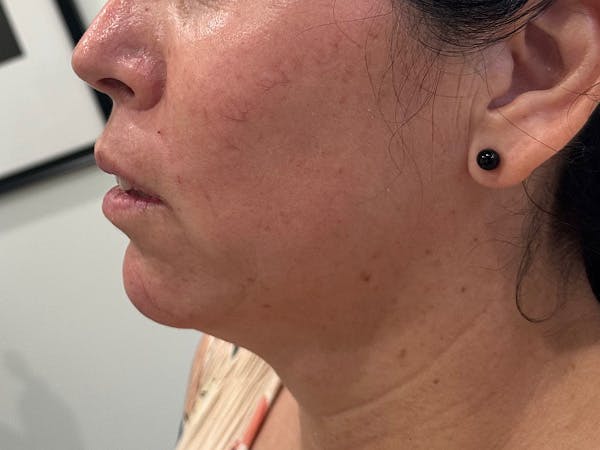 Chin Filler Before & After Gallery - Patient 934061 - Image 2