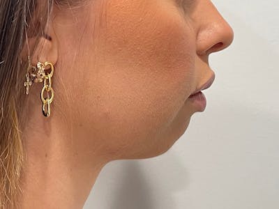 Chin Filler Before & After Gallery - Patient 153796 - Image 1