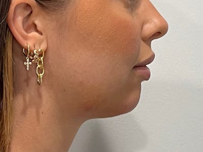 Chin Filler Before & After Gallery - Patient 153796 - Image 2