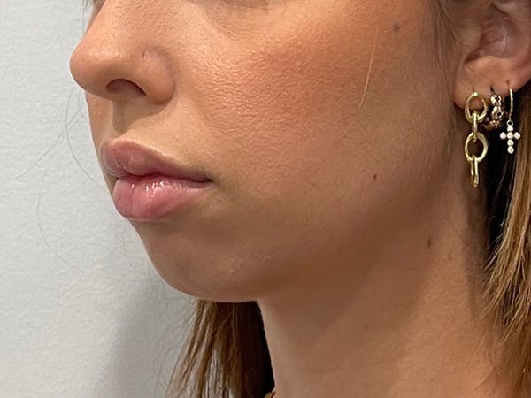 Chin Filler Before & After Gallery - Patient 153796 - Image 3