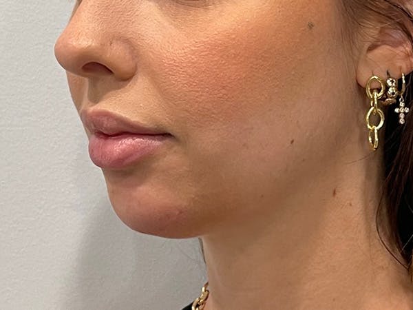 Chin Filler Before & After Gallery - Patient 153796 - Image 4