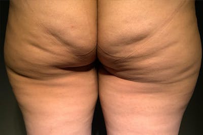 Cellfina Before & After Gallery - Patient 832966 - Image 1
