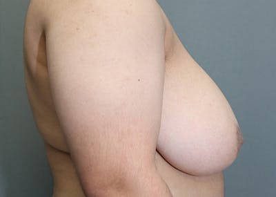Top Surgery Before & After Gallery - Patient 251967 - Image 1