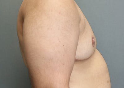 Top Surgery Before & After Gallery - Patient 251967 - Image 2