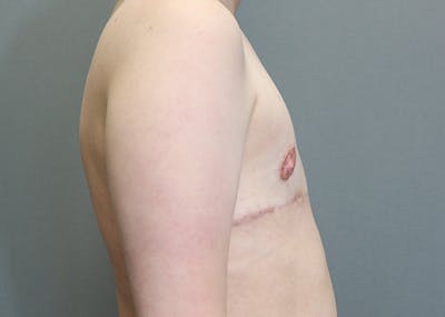 Top Surgery Before & After Gallery - Patient 103811 - Image 2