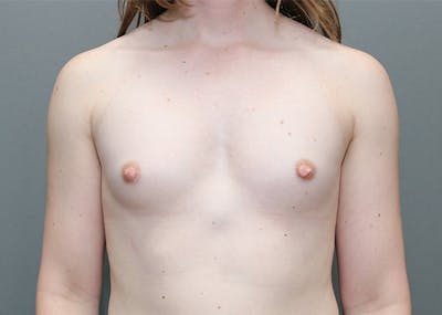 Top Surgery Before & After Gallery - Patient 422975 - Image 1