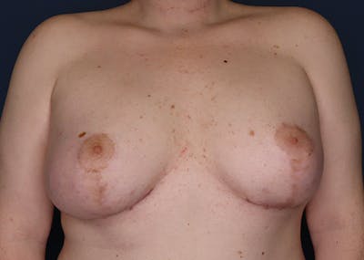 Top Surgery Before & After Gallery - Patient 427164 - Image 2