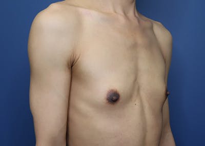Top Surgery Before & After Gallery - Patient 399315 - Image 1