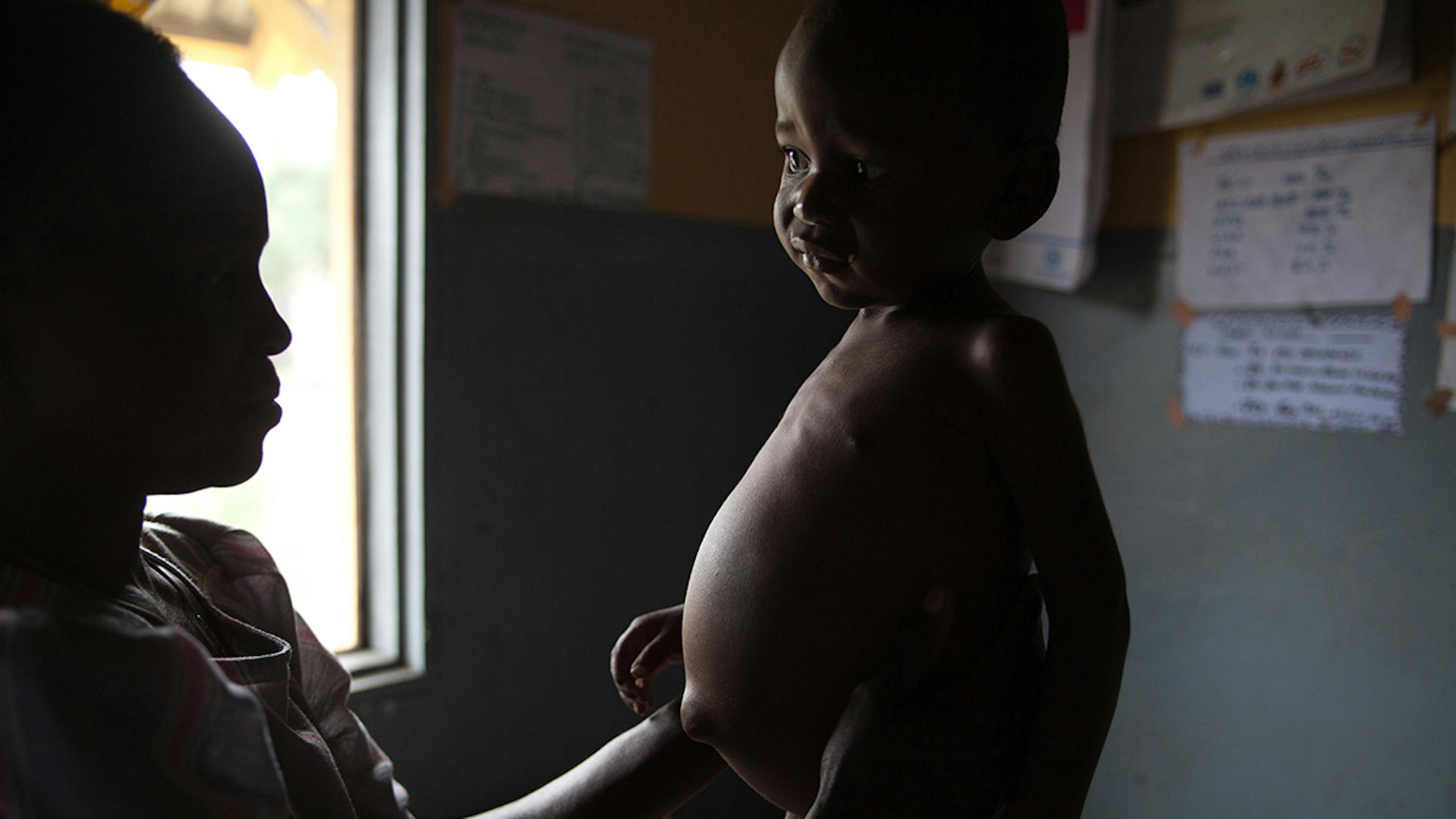 Congo, in un centro nutrizionale un bambino malnutrito viene visitato
