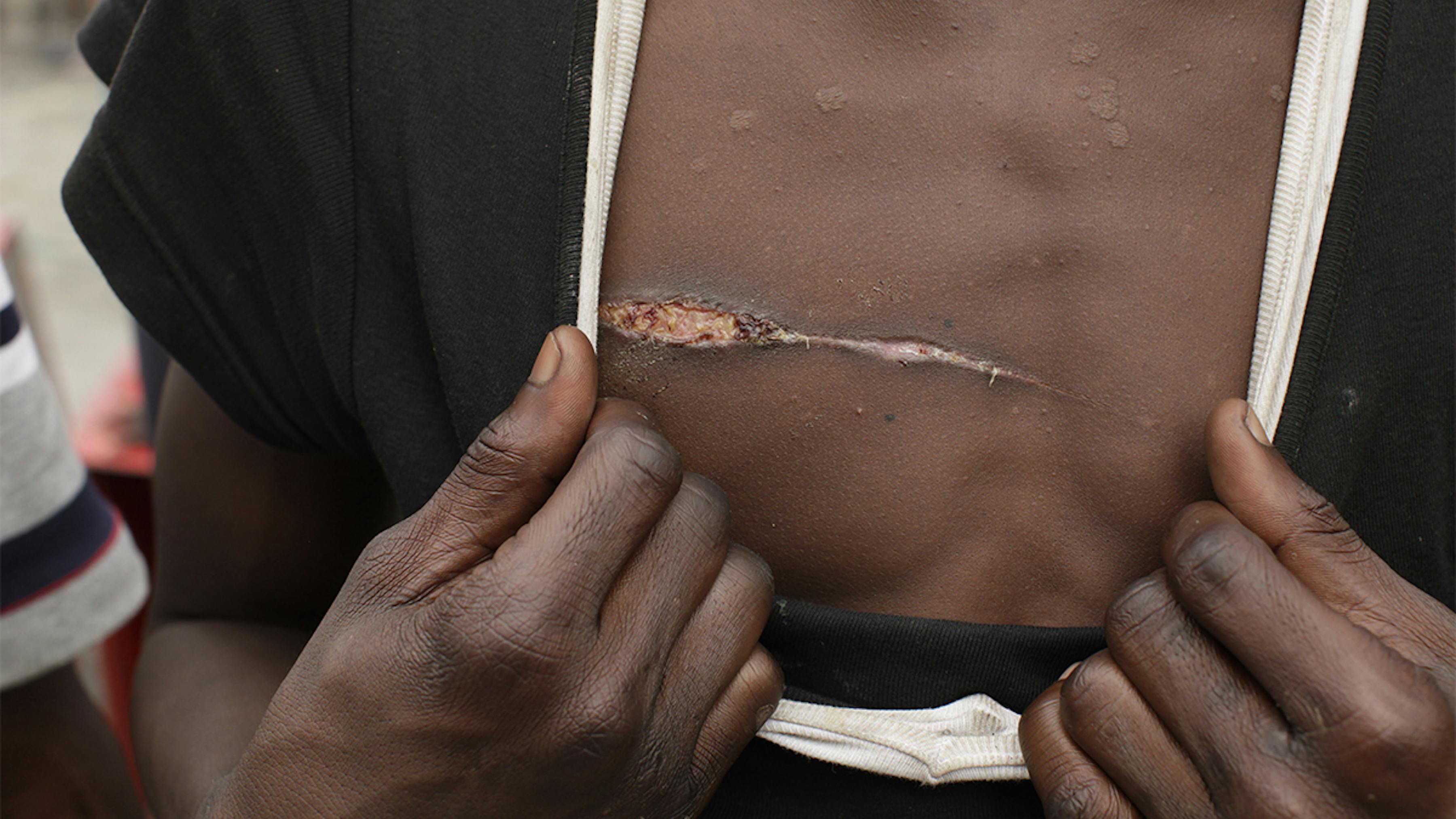 Costa d'Avorio, un ragazzo mostra la cicatrice sul petto causata da un'aggressione.
