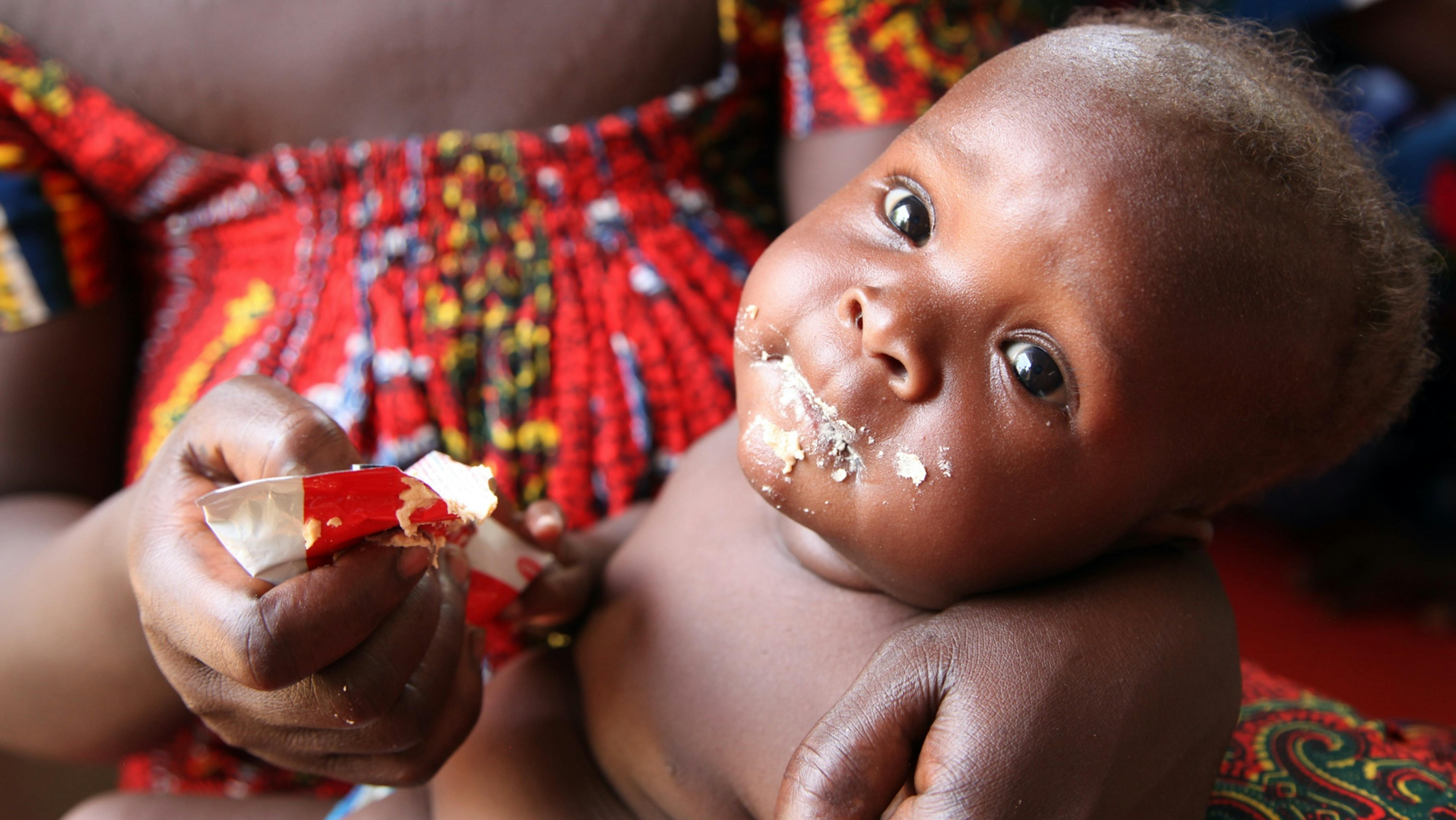 Un bambino malnutrito viene nutrito con l'alimento terapeutico pronto all'uso.