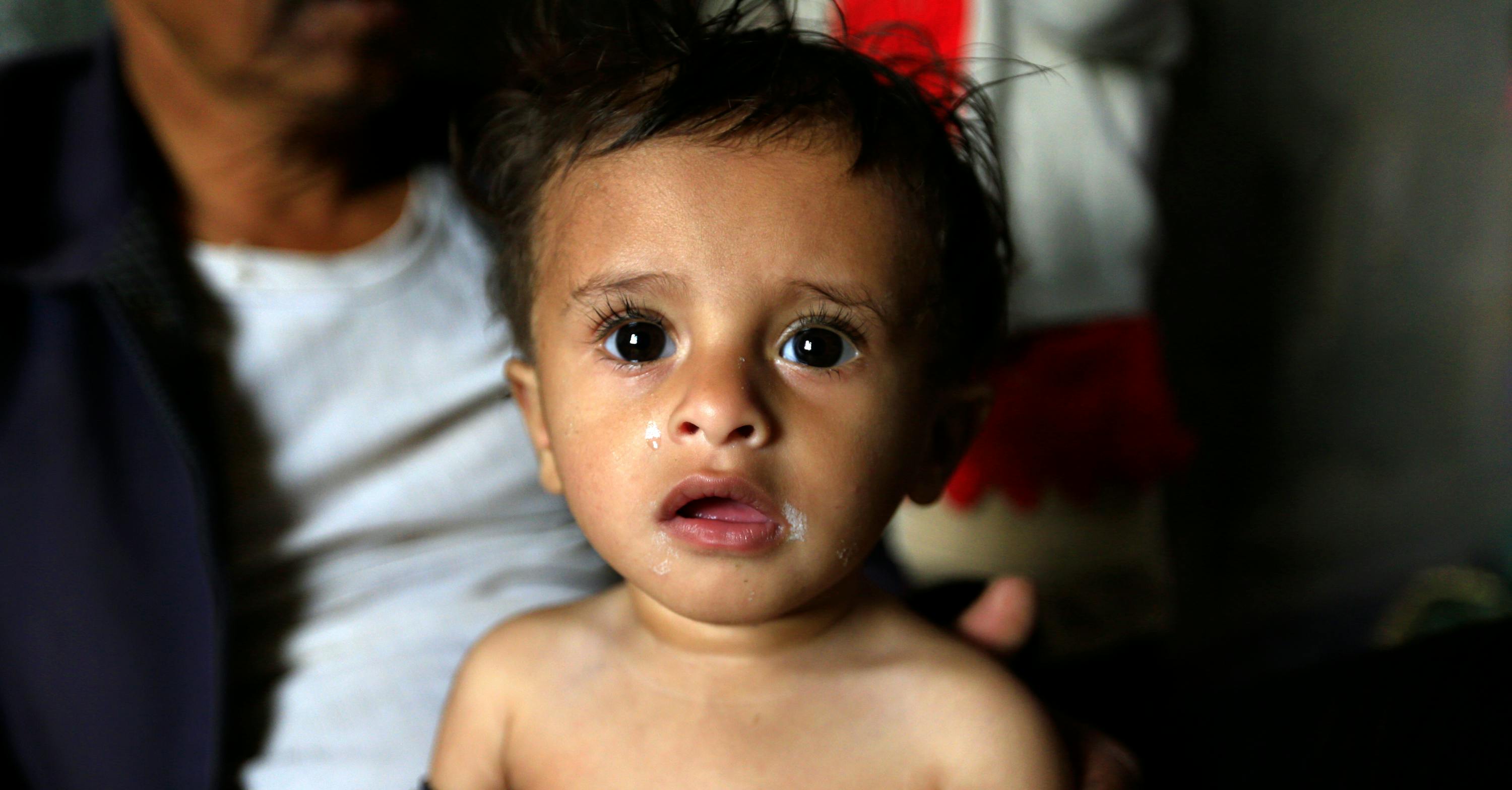 Un bambino yemenita viene assistito da UNICEF insieme alla sua famiglia per malnutrizione