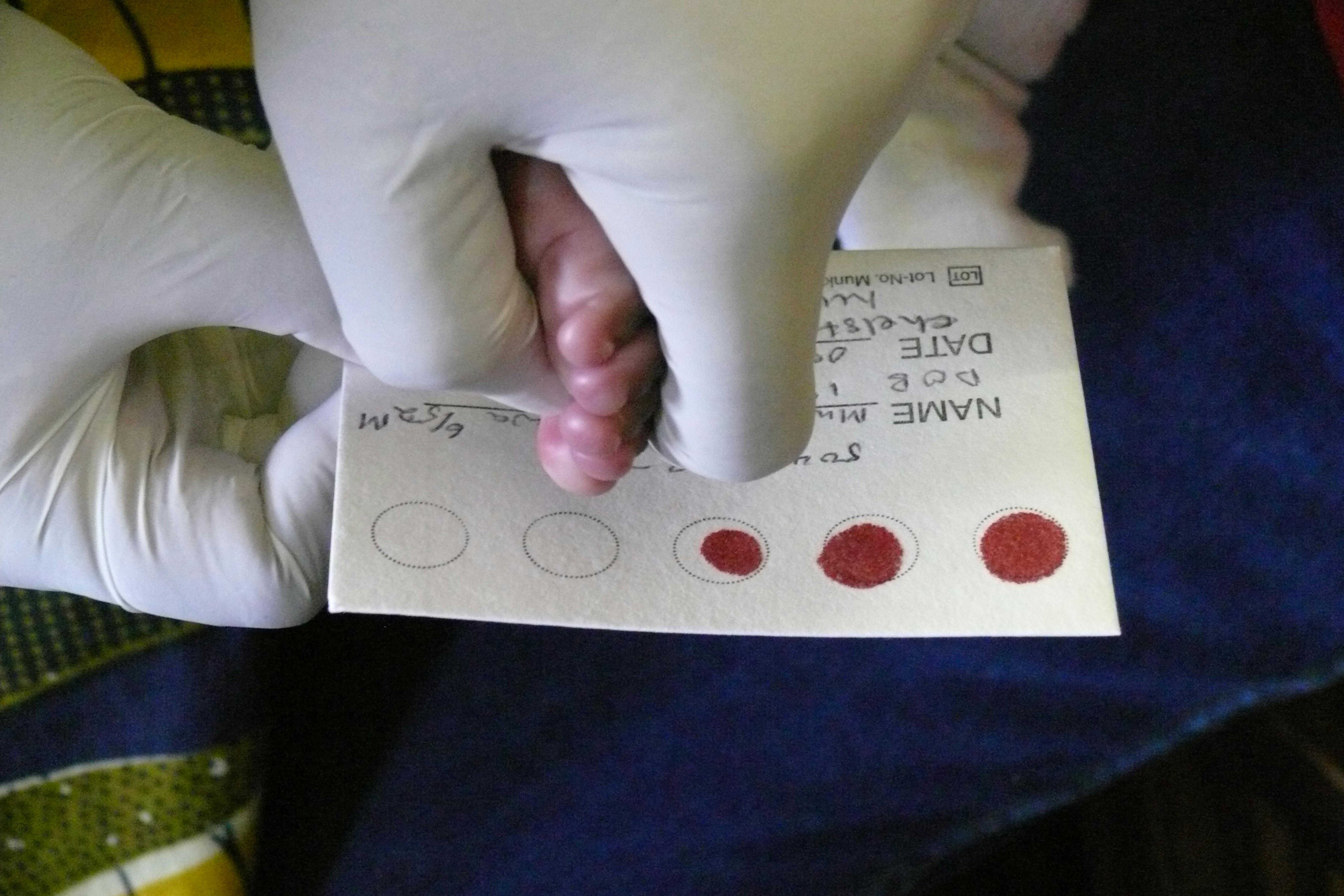 Esame del sangue su una neonata con madre sieropositiva in un ospedale di Chelstone (Zambia)