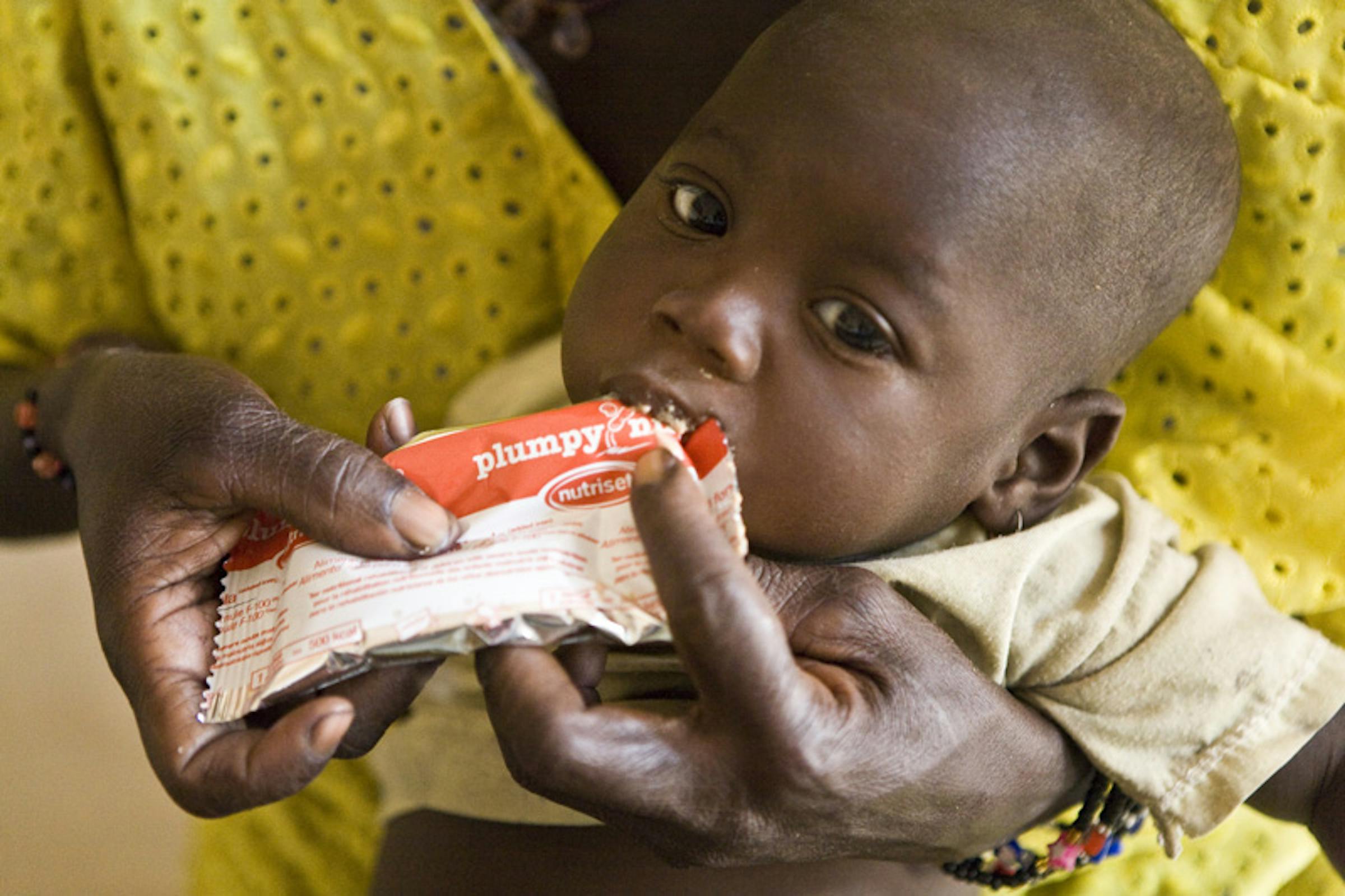 Un bambino affetto da malnutrizione grave con una dose di Plumpynut, un alimento terapeutico pronto per l'uso: foto scattata a Djenne, nella regione di Mopti (Mali) - ©UNICEF Mali/2012-0047/Harandane Dicko