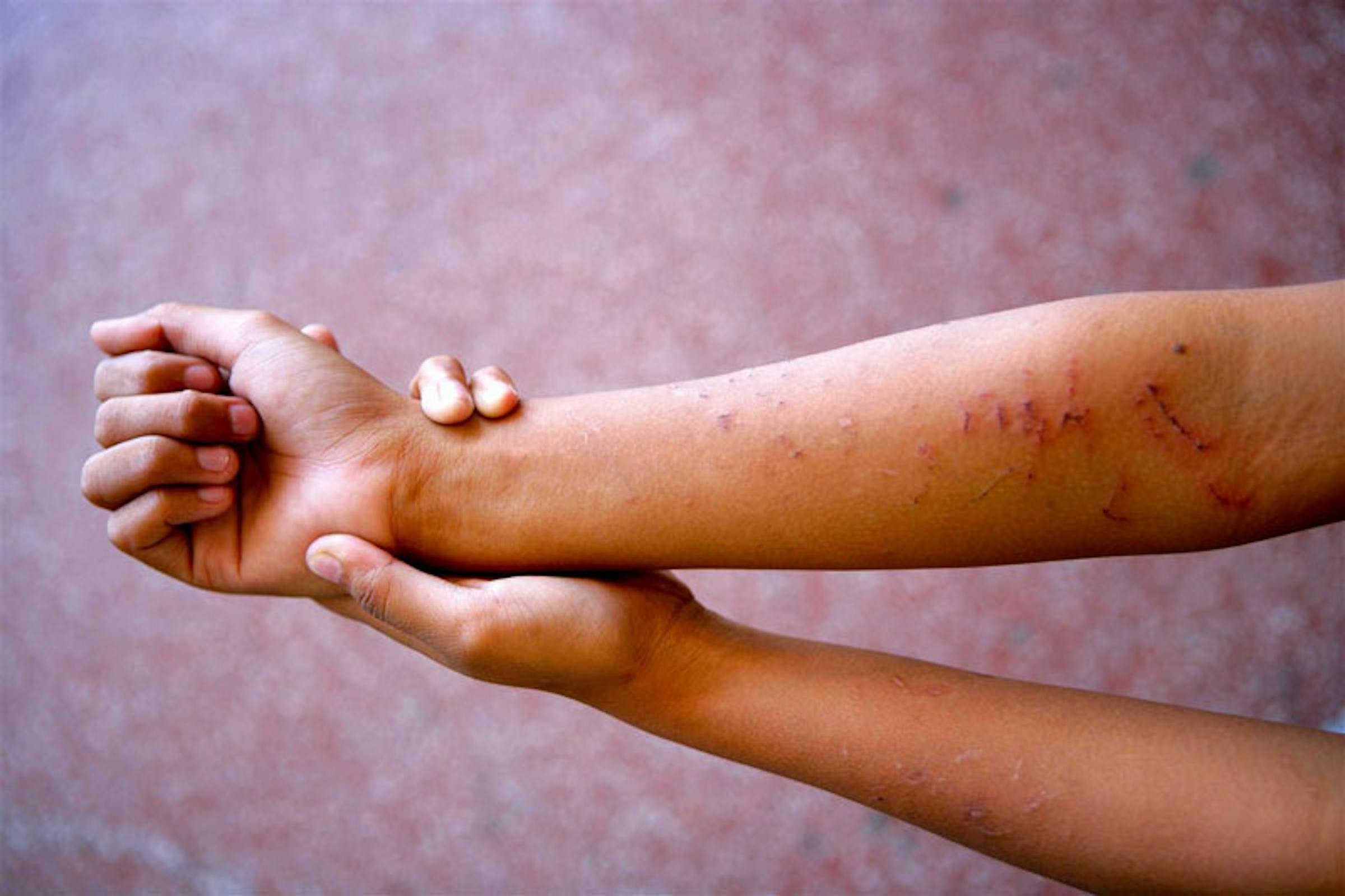 Segni di violenza sulle braccia di questa ragazza di 16 anni, seviziata in famiglia a Manila (Filippine) - ©UNICEF/NYHQ2013-2378/Giacomo Pirozzi 