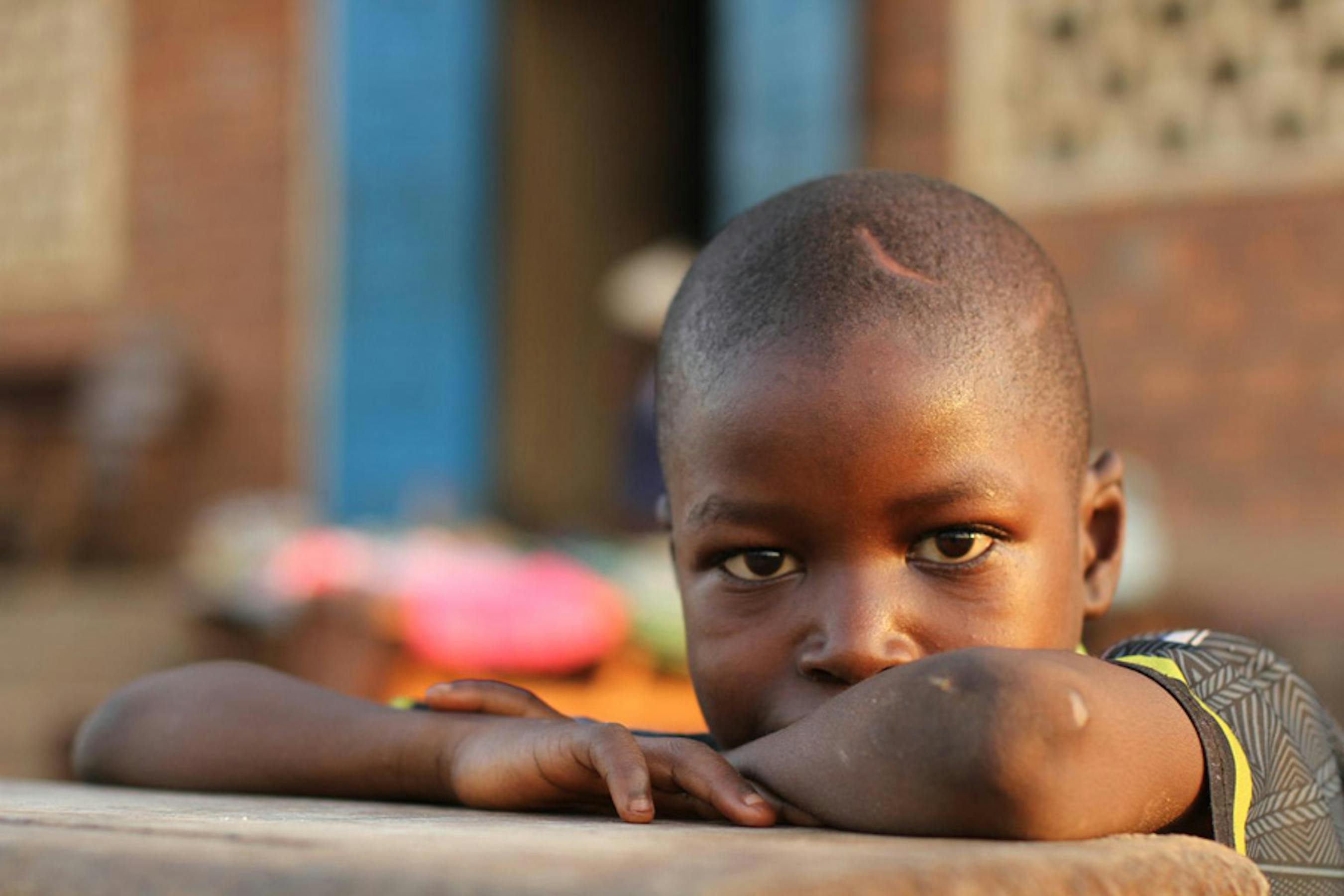 Adamou, 10 anni, vive con la mamma e un fratello in un campo profughi a Bossangoa, nella Repubblica Centrafricana. Sulla testa ha la cicatrice di un colpo di machete - ©UNICEF/NYHQ2013-1001/Gabrielle Menezes