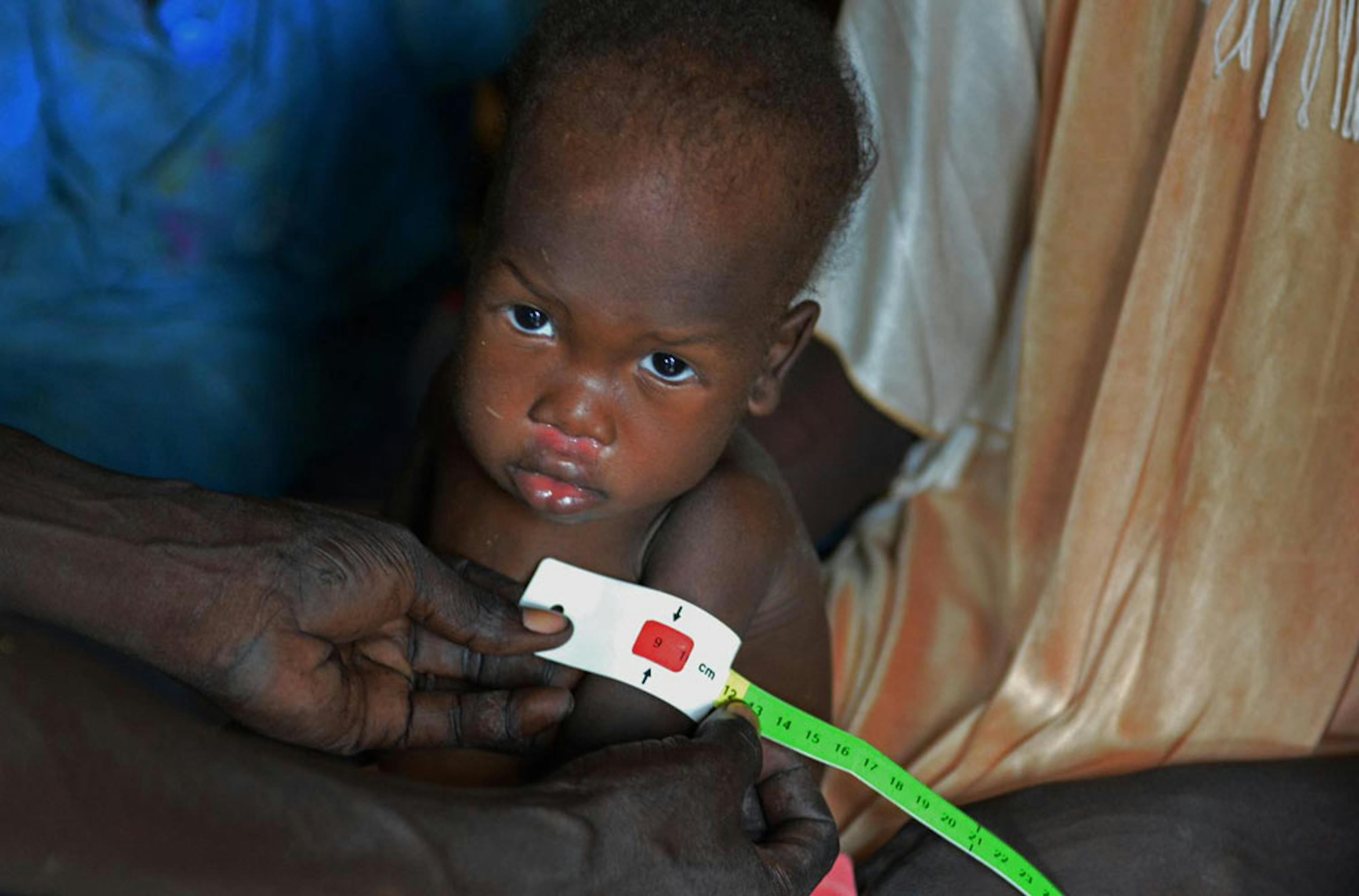 Il colore rosso del braccialetto MUAC rivela che la piccola Nyarony, 3 anni, è affetta da malnutrizione grave. La famiglia di Nyarony è sfollata in un accampamento presso la base ONU di Malakal, nel Sud Sudan - ©UNICEF/NYHQ2014-1415/Nesbitt