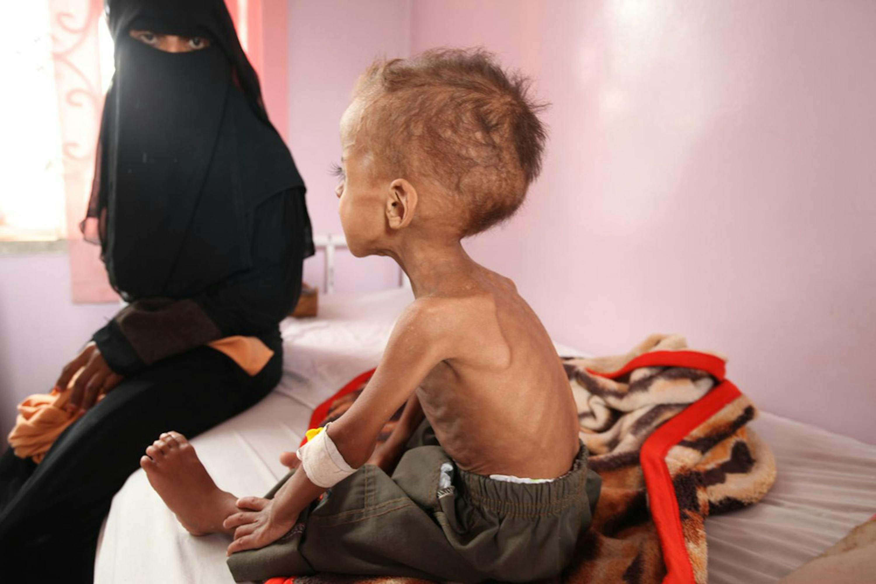 Faisal ha 18 mesi: da quando è iniziato il conflitto nello Yemen, 6 mesi fa, il suo peso è sceso da 12 a 5 chili. Faisal è in cura presso l'ospedale Al Sabeen di Sana'a, capitale dello Yemen - ©UNICEF/UNI191723/Yasmin