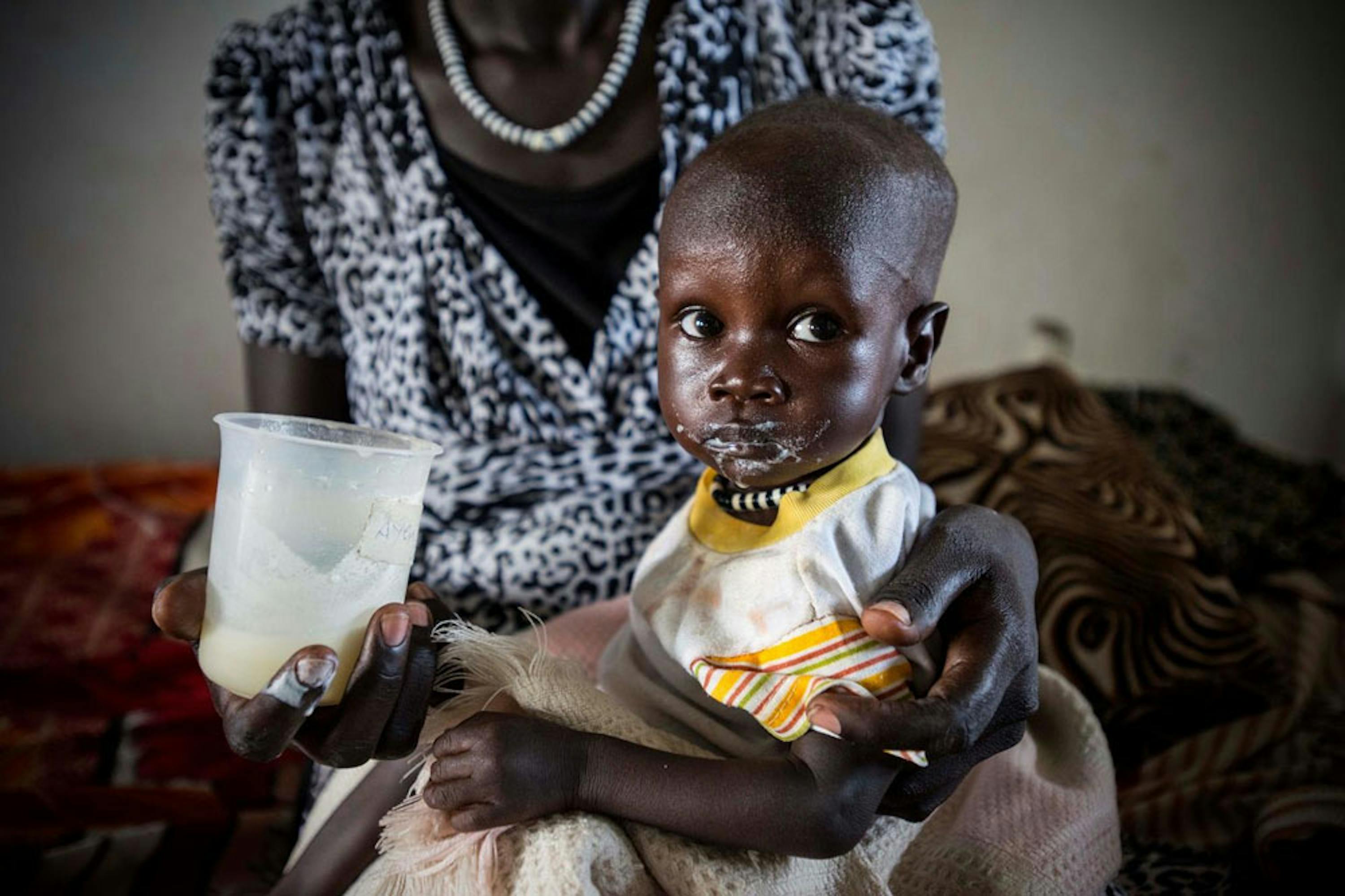 Ayen, 10 mesi, ricoverata per grave denutrizione nell'ospedale di Bor (Sud Sudan) sostenuto dall'UNICEF. Il suo peso è poco più di metà della media per la sua età - ©UNICEF/UNI198874/Rich