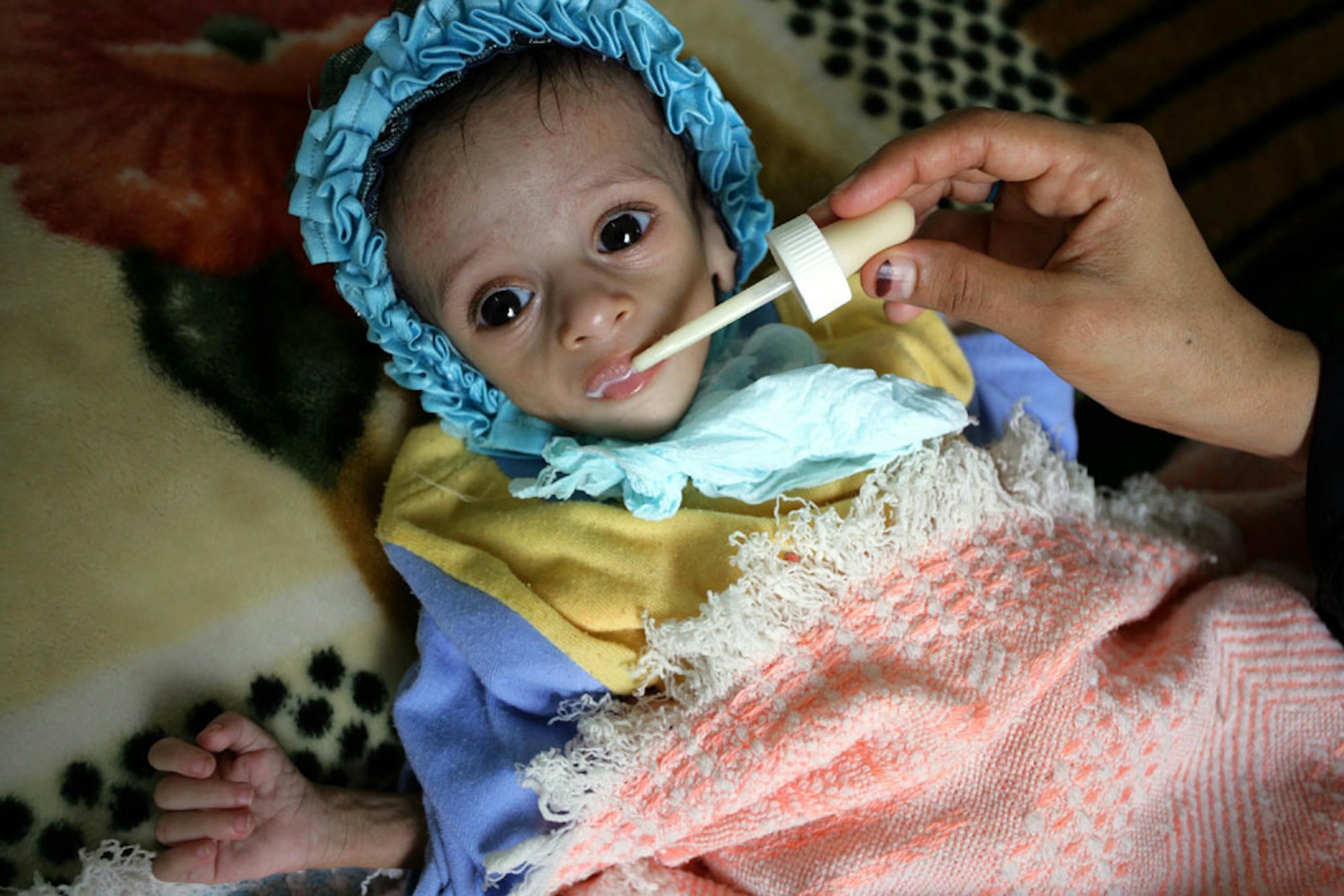 Nello Yemen in guerra, malnutrizione e malattie stanno provocando fra i bambini un numero di decessi molto più alto rispetto ai bombardamenti - ©UNICEF/UNI48543/Mohammed Mahmoud
