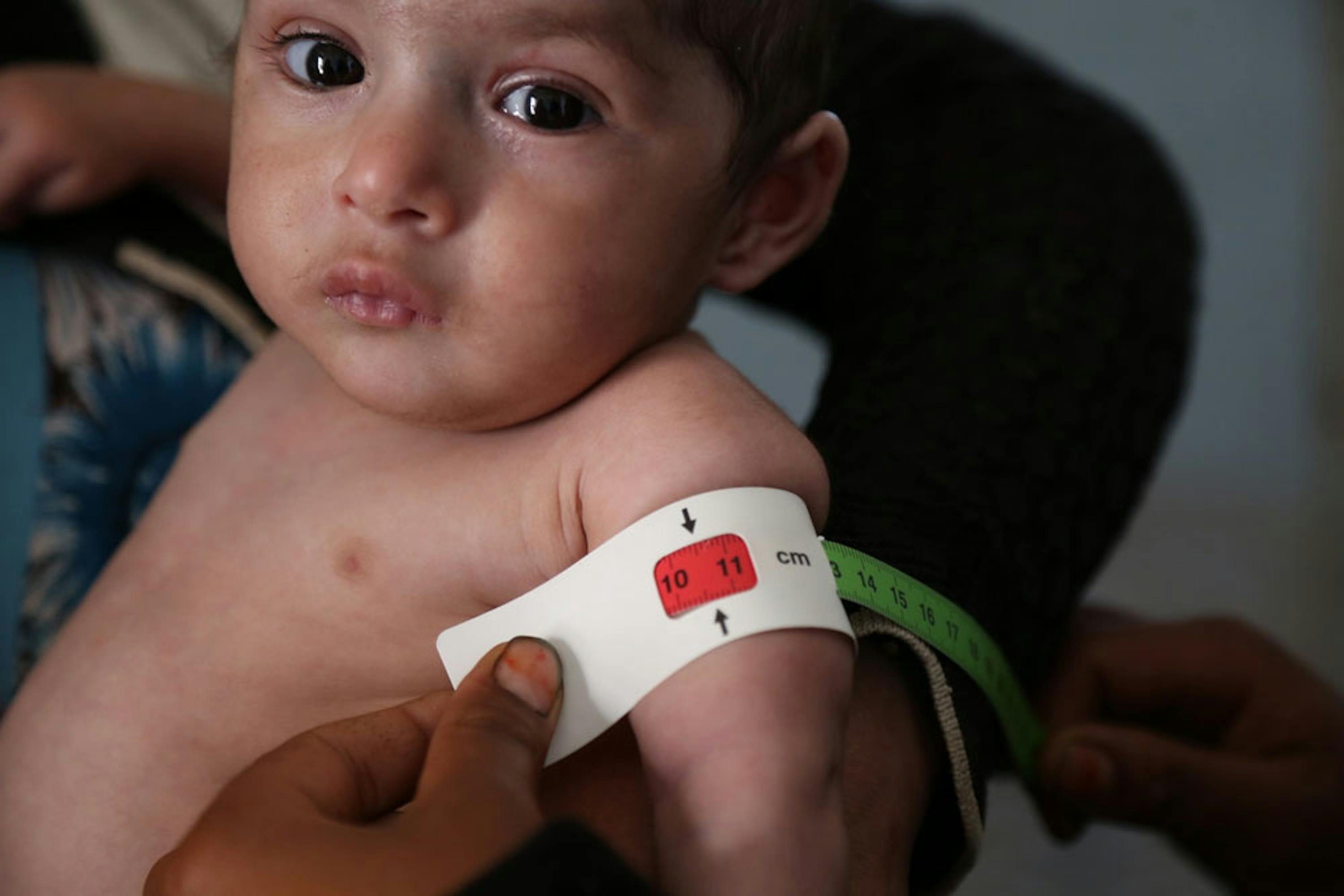 Il braccialetto MUAC rivela lo stato di malnutrizione grave acuta di questo bambino ricoverato nell'ospedale Ma'abar, nel governatorato di Dhamar (Yemen) - ©UNICEF/UN057346/Madhok