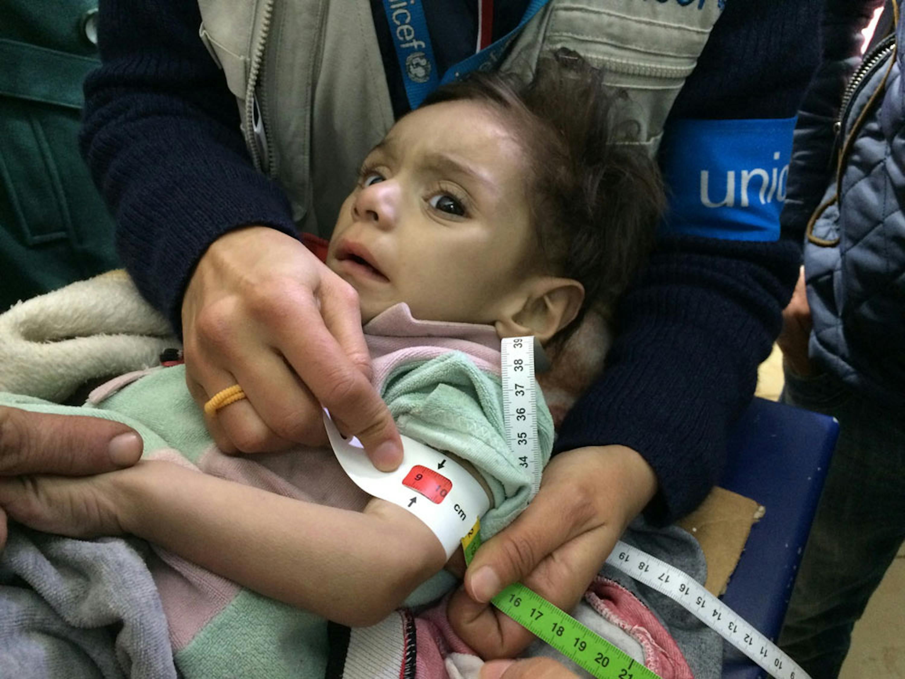 Una bambina viene visitata nell'ospedale di Madaya dagli operatori umanitari appena entrati in città. Il colore rosso del braccialetto MUAC non lascia dubbi sulla sua gravissima forma di denutrizione - ©UNICEF/UN07558/Singer