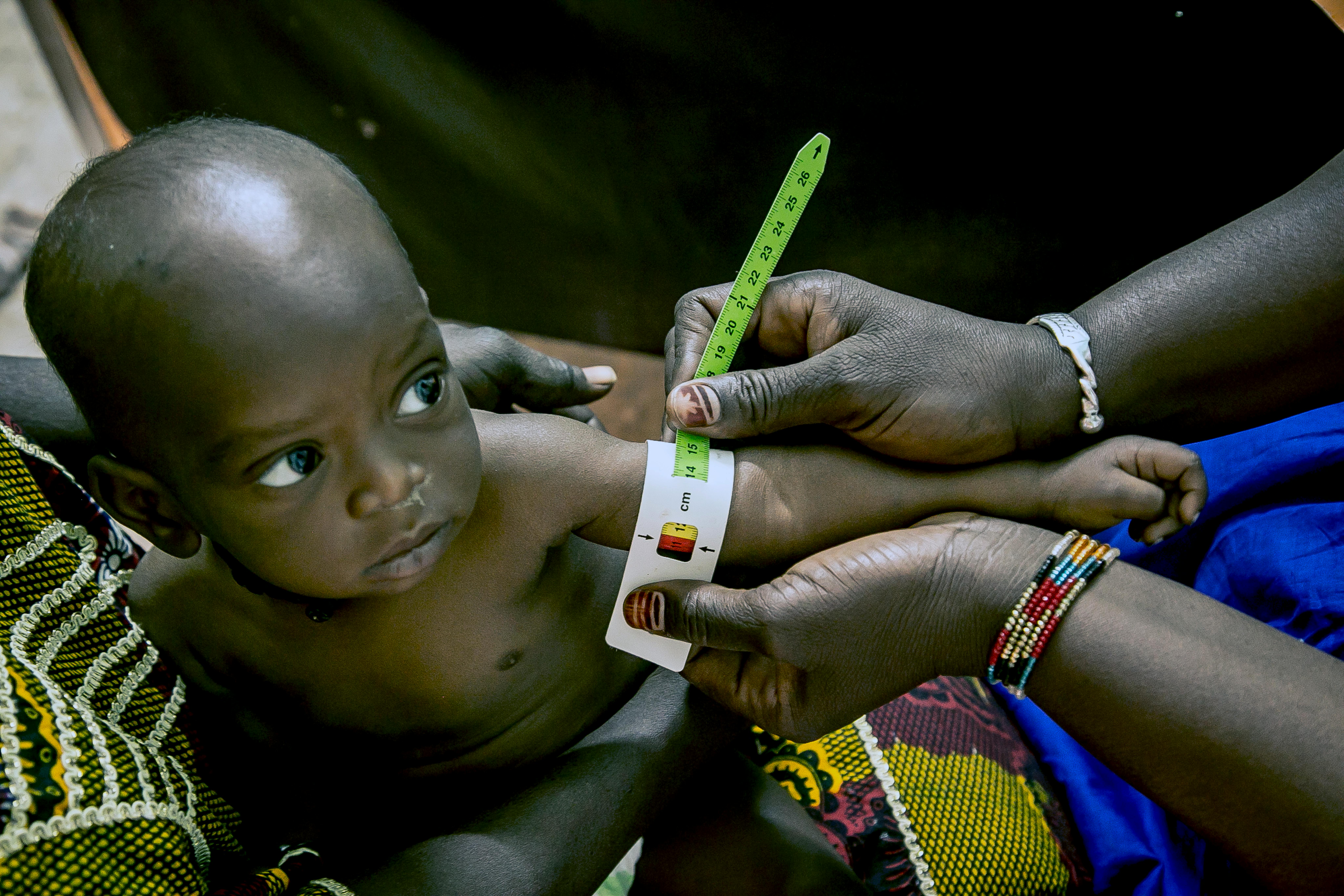Visita medica a un bambino malnutrito