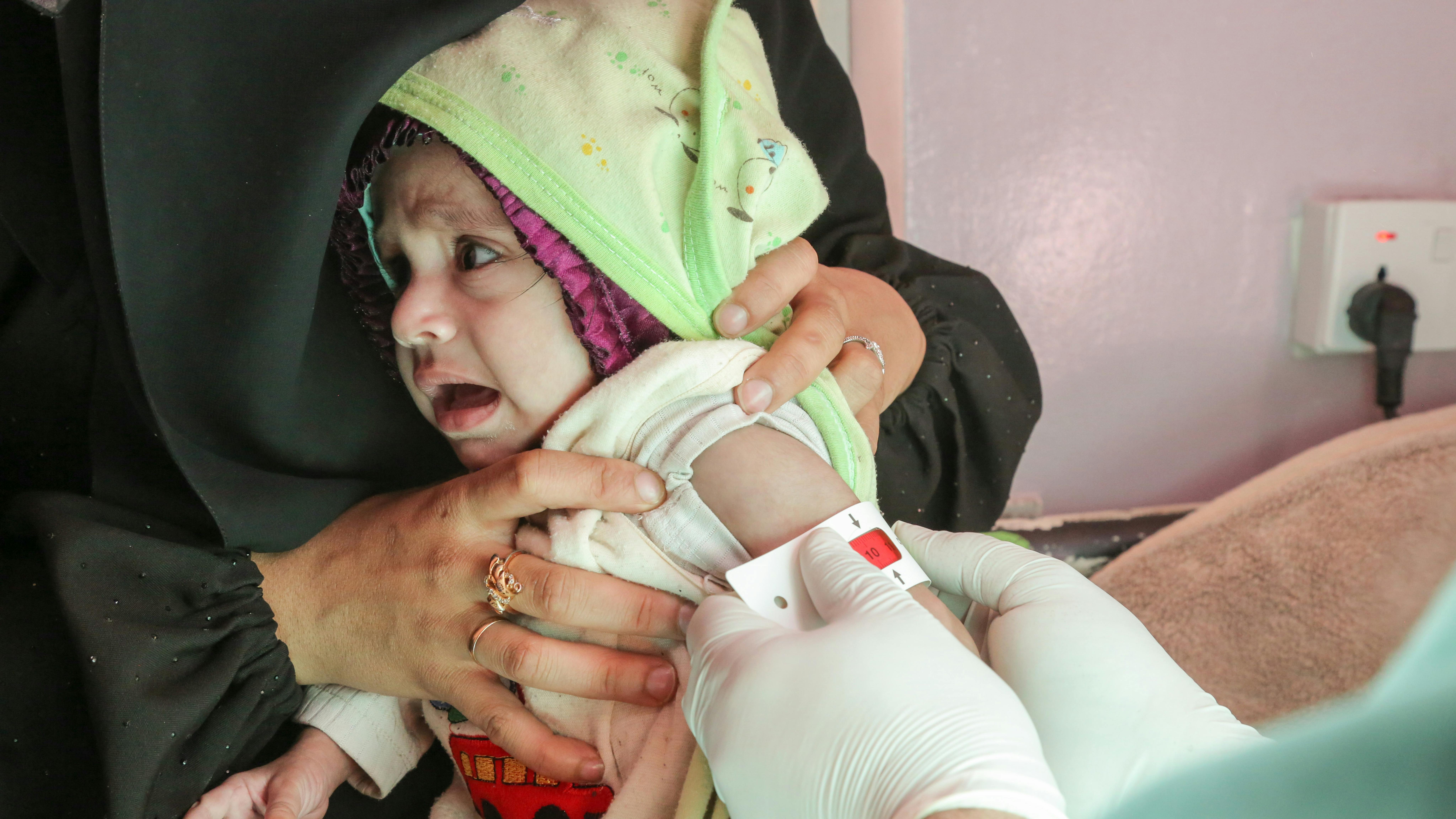 La piccola bambina Rawabi Mutahar Ahmed Hassan, 7 mesi, mentre le viene misurata la circonferenza del braccio (MUAC) per determinare se è gravemente malnutrita, presso l'ospedale Al-Sabeen sostenuto dall'UNICEF a Sana'a, nello Yemen.