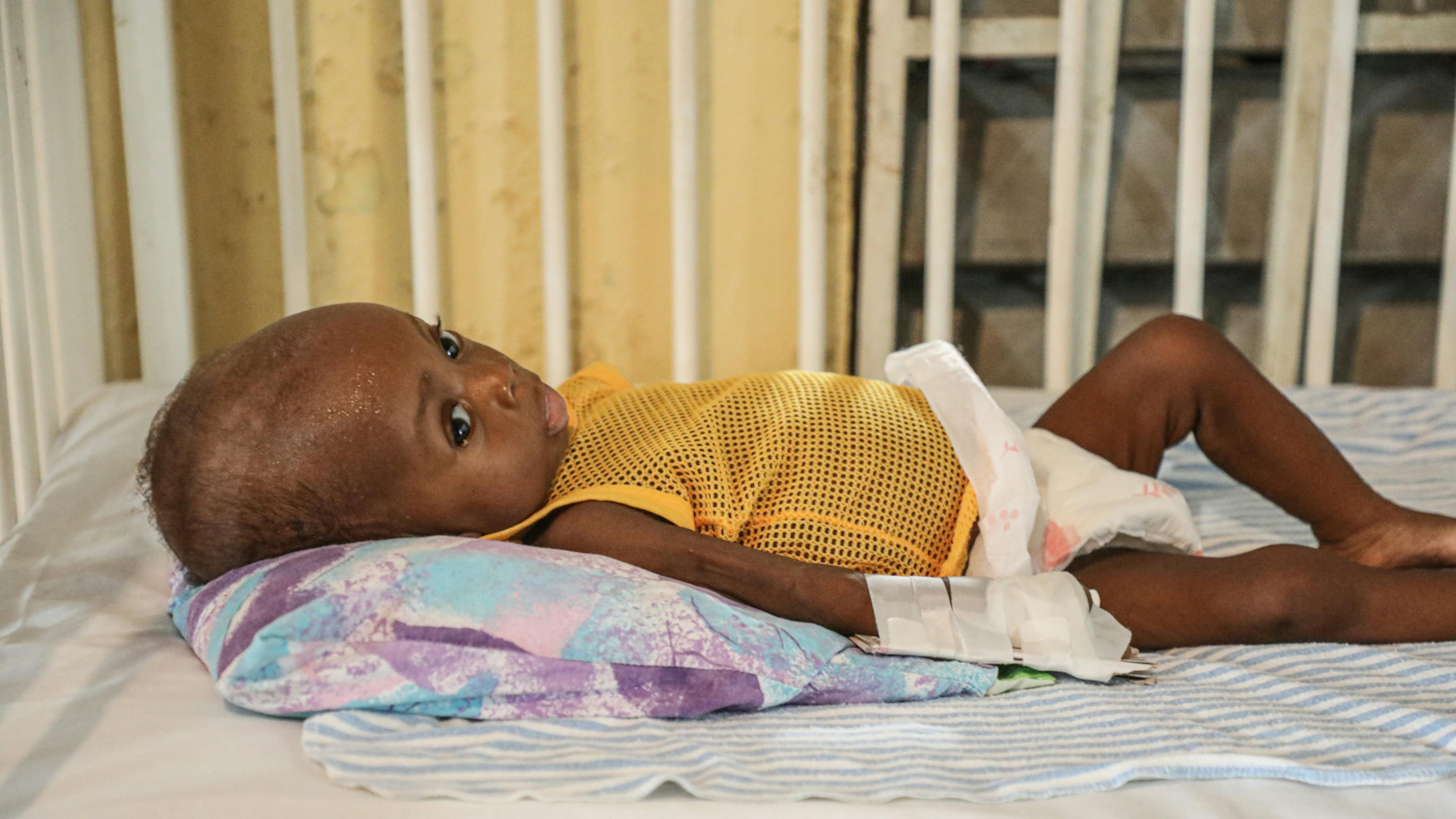Haiti, un  bambino malnutrito nel  l'unità pediatrica dell'Hospital Immaculee Conception